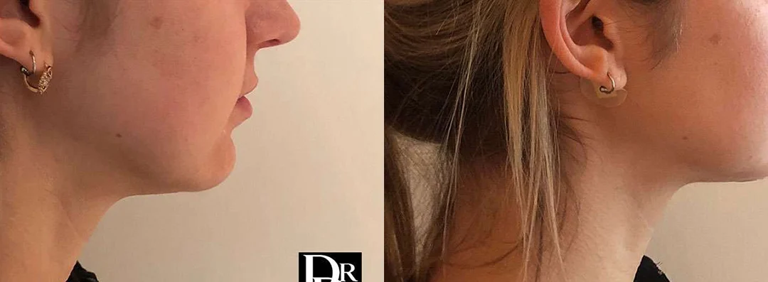 Neck Lift Before And After Photos By Dr. Demetri Arnaoutakis In Tampa, Fl