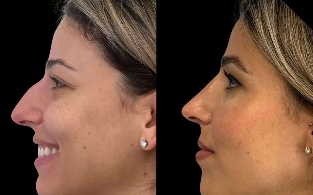 Rhinoplasty before and after photos by Dr. Demetri Arnaoutakis in Tampa, FL