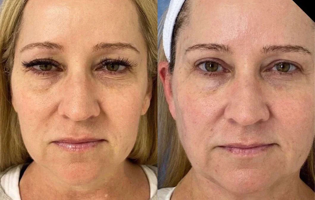 Eyelid Surgery before and after photos by Dr. Demetri Arnaoutakis in Tampa, FL