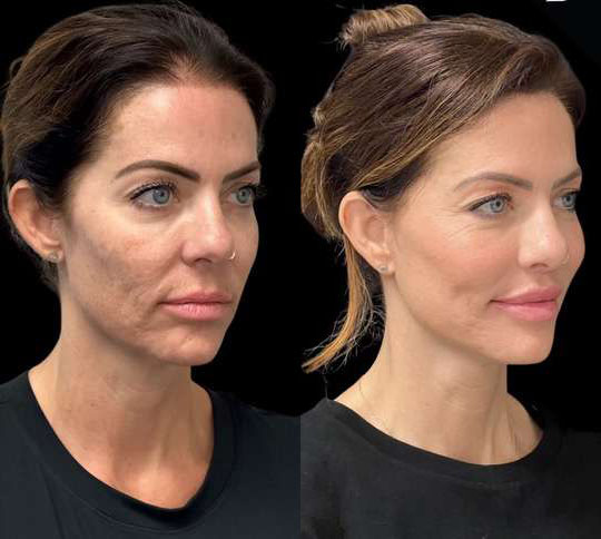 Facelift Before And After Photos By Dr. Demetri Arnaoutakis In Tampa, Fl