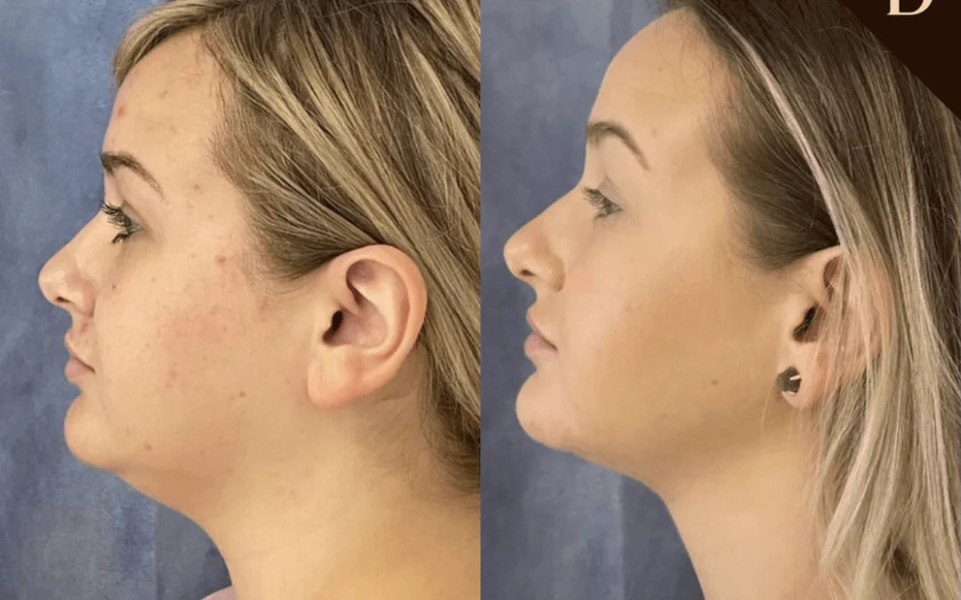 Facetite Before And After Photos By Dr. Demetri Arnaoutakis In Tampa, Fl