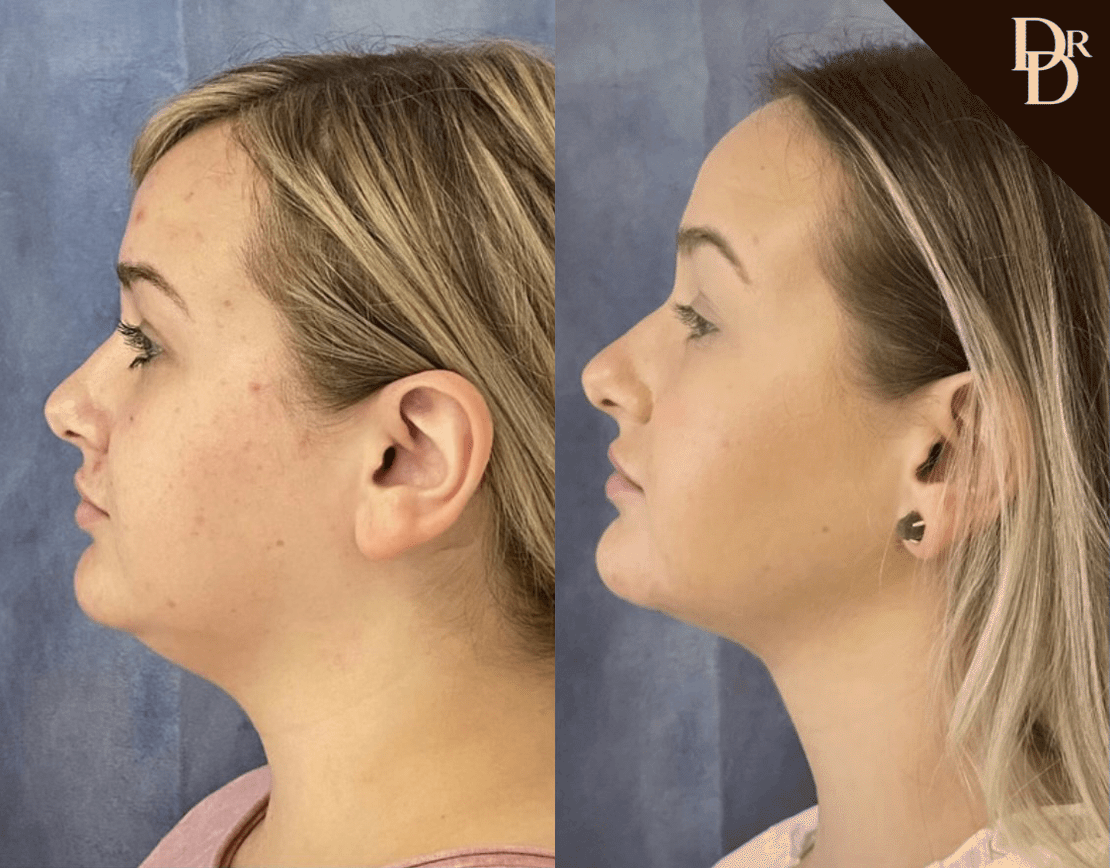Facetite Before And After Photos By Dr. Demetri Arnaoutakis In Tampa, Fl
