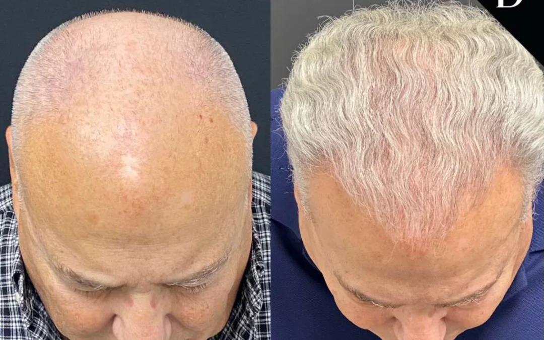 Hair Transplant Before And After Photos By Dr. Demetri Arnaoutakis In Tampa, Fl