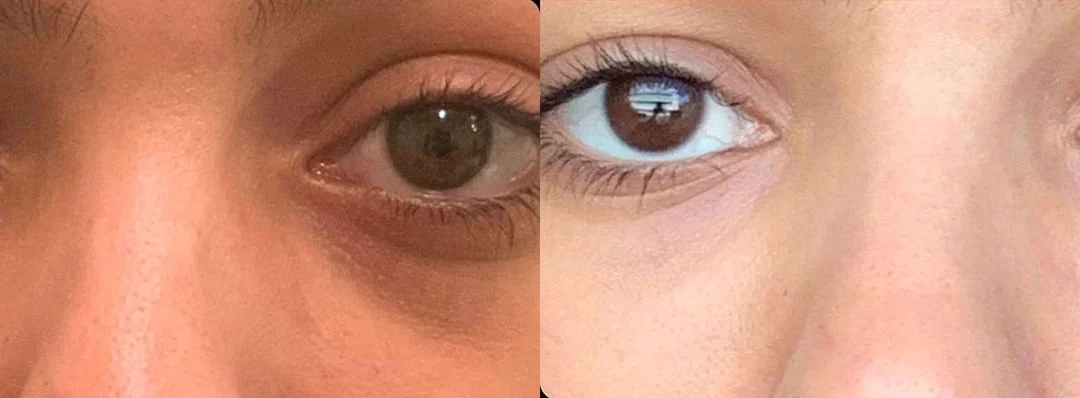 Injectable/Dermal Fillers Before And After Photos By Dr. Demetri Arnaoutakis In Tampa, Fl