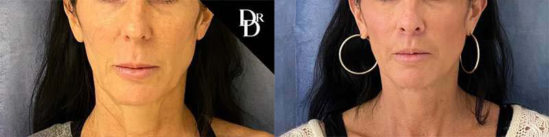 Lip Lift before and after photos by Dr. Demetri Arnaoutakis in Tampa, FL