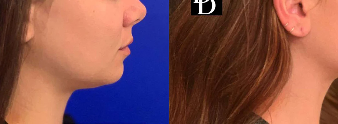 Neck Lift Before And After Photos By Dr. Demetri Arnaoutakis In Tampa, Fl