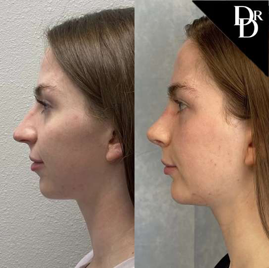 Rhinoplasty before and after photos by Dr. Demetri Arnaoutakis in Tampa, FL