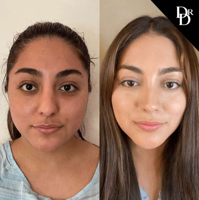 Buccal Fat Pad Removal before and after photos by Dr. Demetri Arnaoutakis in Tampa, FL