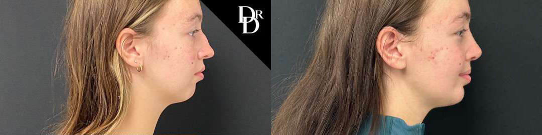 Chin Augmentation before and after photos by Dr. Demetri Arnaoutakis in Tampa, FL