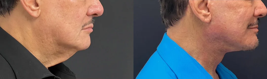 Facelift Before And After Photos By Dr. Demetri Arnaoutakis In Tampa, Fl