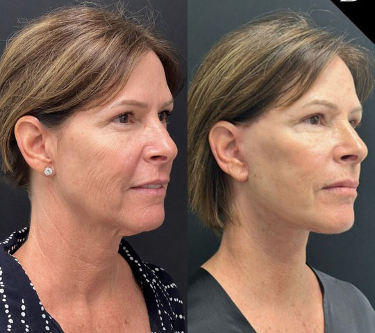 Facelift Before And After Photos By Dr. Demetri Arnaoutakis In Tampa, Fl