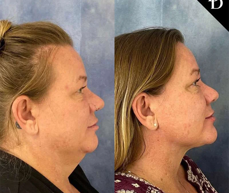 Facetite Before And After Photos By Dr. Demetri Arnaoutakis In Tampa, Fl