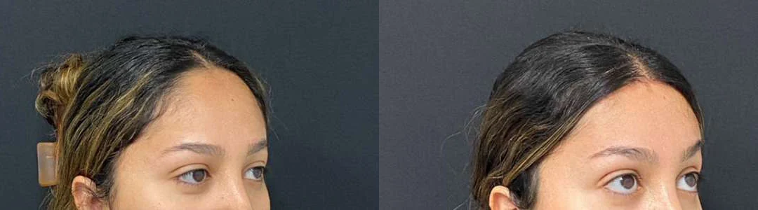 Hairline Lowering Surgery Before And After Photos By Dr. Demetri Arnaoutakis In Tampa, Fl