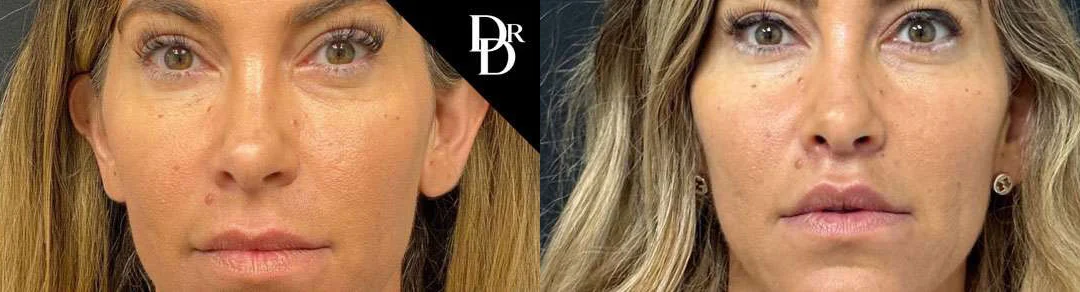 Lip Lift before and after photos by Dr. Demetri Arnaoutakis in Tampa, FL