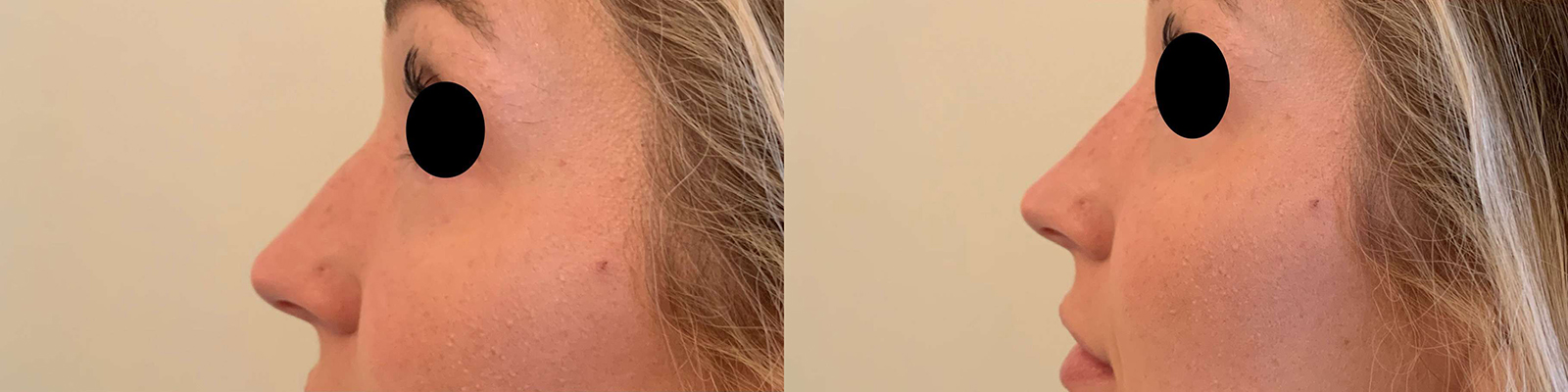 Liquid Rhinoplasty Before And After Photos By Dr. Demetri Arnaoutakis In Tampa, Fl