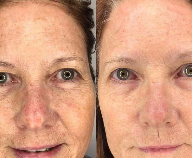 Microneedling Before And After Photos By Dr. Demetri Arnaoutakis In Tampa, Fl