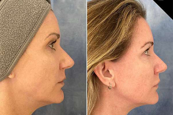 Morpheus8 Before And After Photos By Dr. Demetri Arnaoutakis In Tampa, Fl