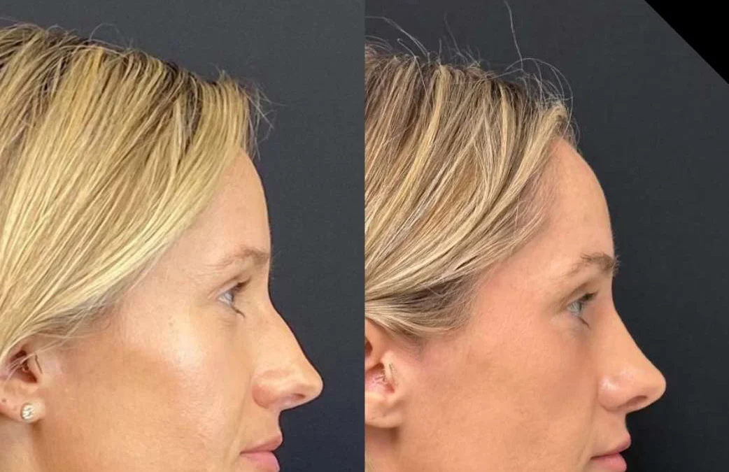 Rhinoplasty before and after photos by Dr. Demetri Arnaoutakis in Tampa, FL
