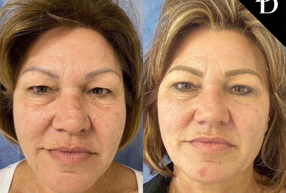 Eyelid Surgery before and after photos by Dr. Demetri Arnaoutakis in Tampa, FL