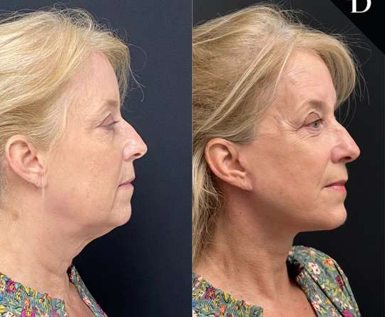 Facelift Before And After Photos By Dr. Demetri Arnaoutakis In Tampa, Fl
