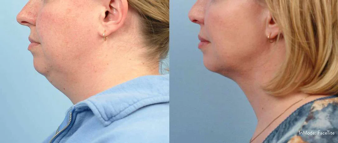 Facetite Before And After Photos By Dr. Demetri Arnaoutakis In Tampa, Fl
