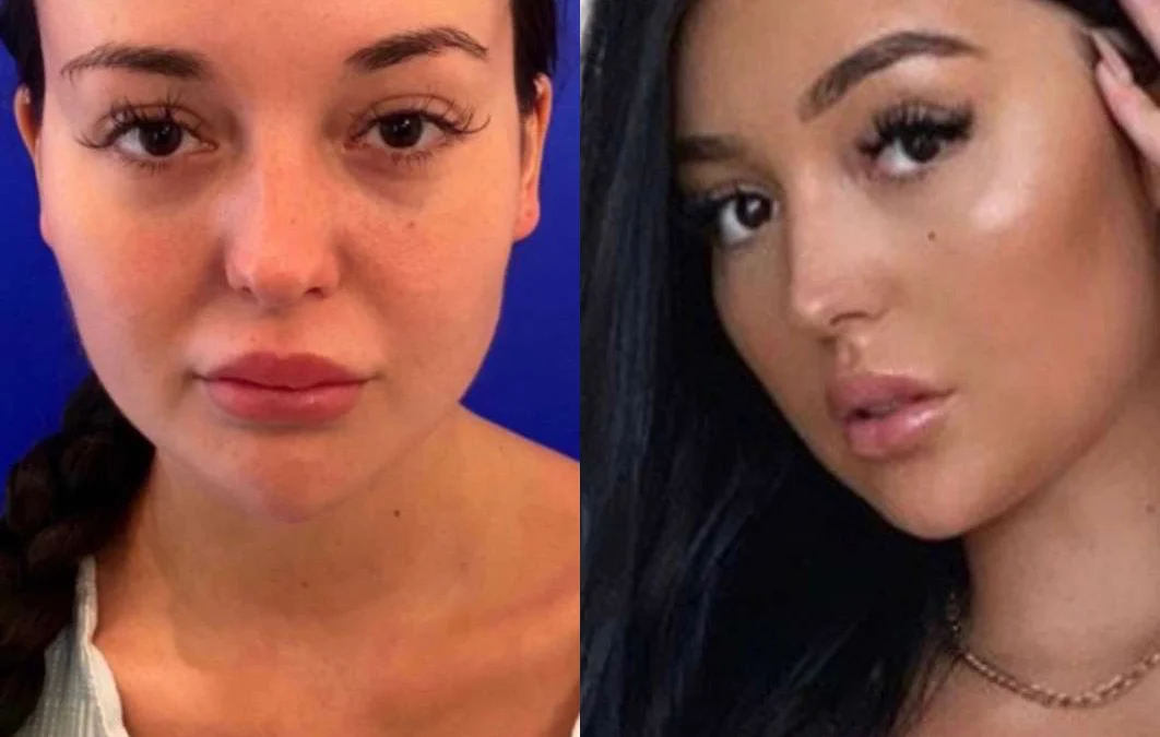 Hairline Lowering Surgery Before And After Photos By Dr. Demetri Arnaoutakis In Tampa, Fl
