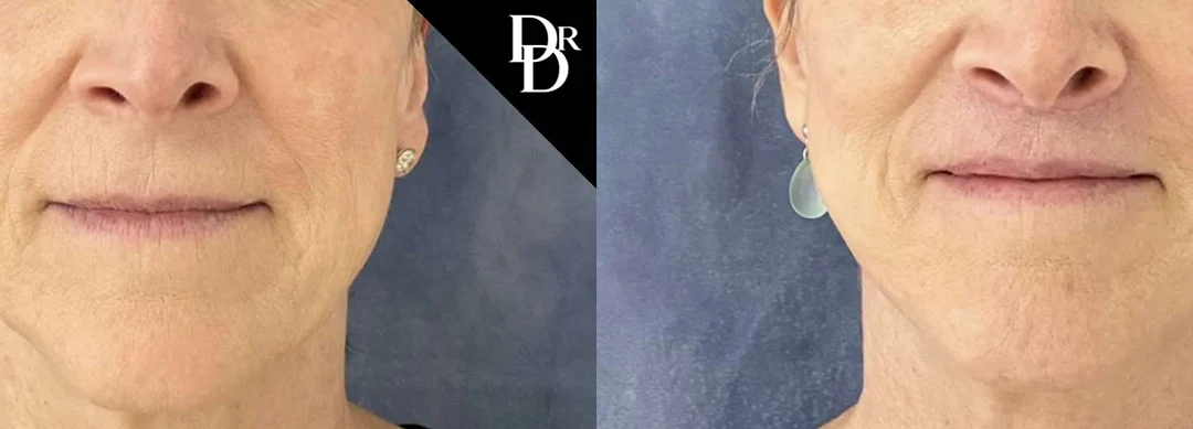 Lip Lift before and after photos by Dr. Demetri Arnaoutakis in Tampa, FL