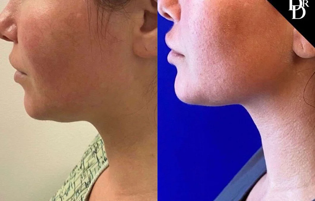 Neck Lift Before And After Photos By Dr. Demetri Arnaoutakis In Tampa, Fl