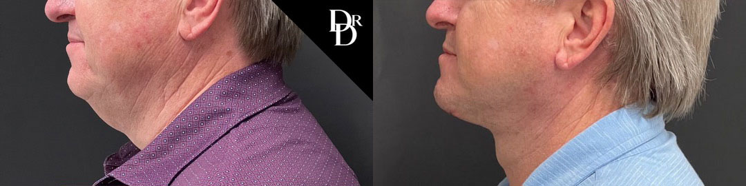 Neck Lift before and after photos by Dr. Demetri Arnaoutakis in Tampa, FL