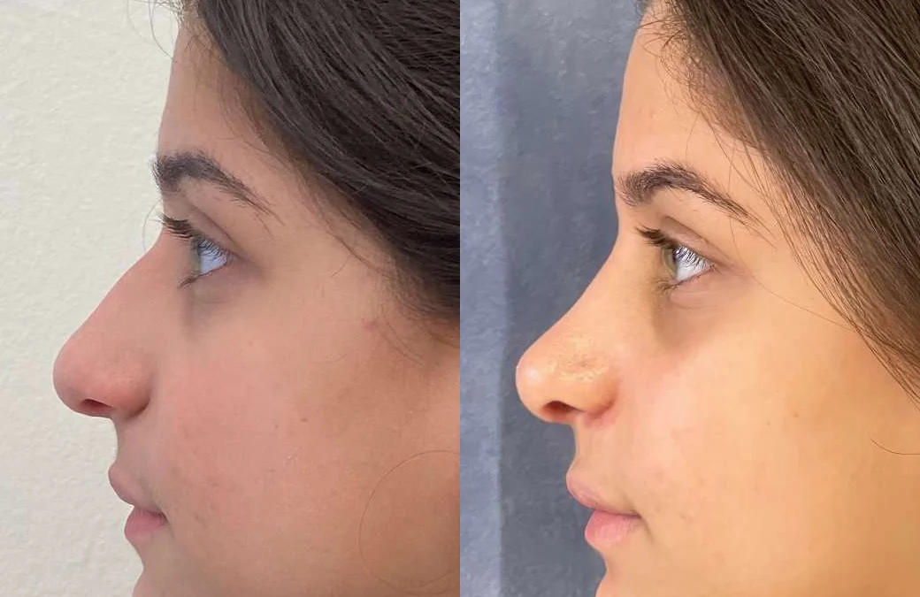 Rhinoplasty before and after photos by Dr. Demetri Arnaoutakis in Tampa, FL