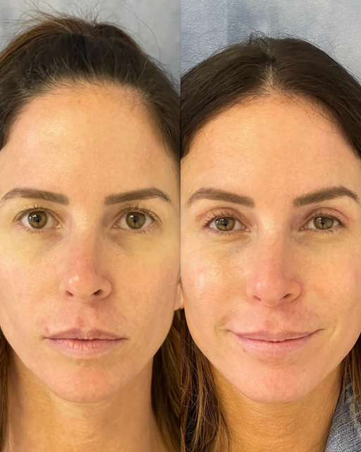 Eyelid Surgery before and after photos by Dr. Demetri Arnaoutakis in Tampa, FL