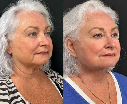 Facelift Before And After Photos By Dr. Demetri Arnaoutakis In Tampa, Fl
