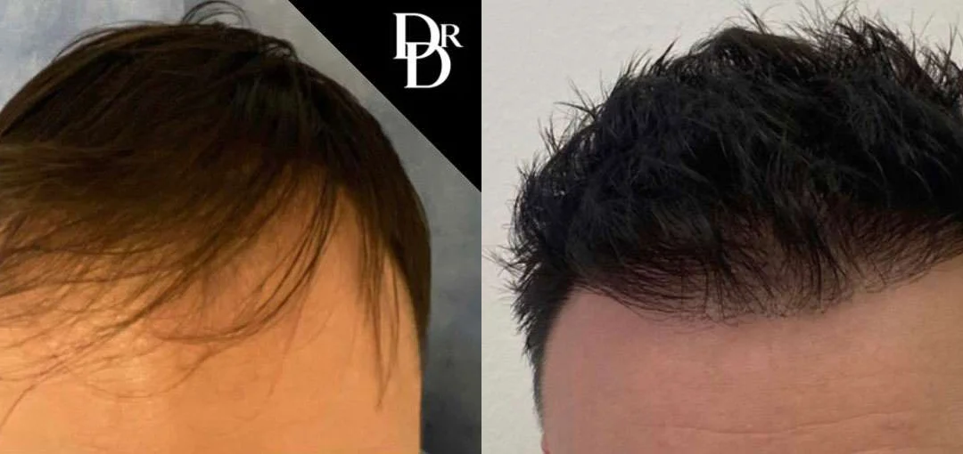 Hair Transplant Before And After Photos By Dr. Demetri Arnaoutakis In Tampa, Fl