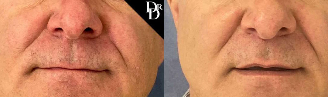 Lip Lift before and after photos by Dr. Demetri Arnaoutakis in Tampa, FL