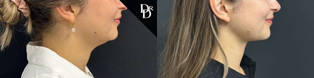 Neck Lift before and after photos by Dr. Demetri Arnaoutakis in Tampa, FL