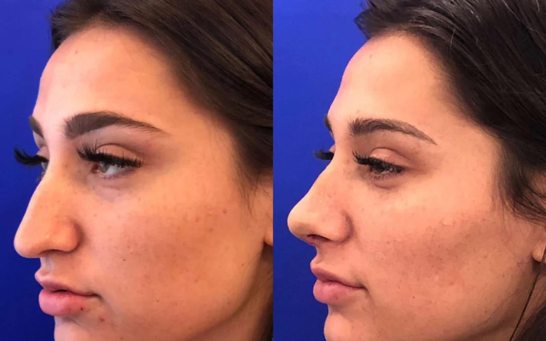 Rhinoplasty before and after photos by Dr. Demetri Arnaoutakis in Tampa, FL