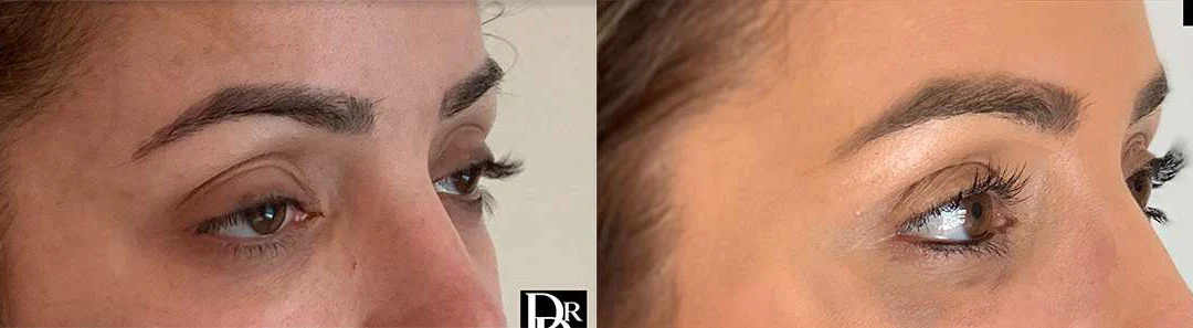 Eyelid Surgery before and after photos by Dr. Demetri Arnaoutakis in Tampa, FL