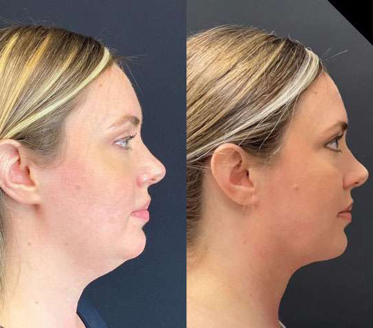 Facetite Before And After Photos By Dr. Demetri Arnaoutakis In Tampa, Fl