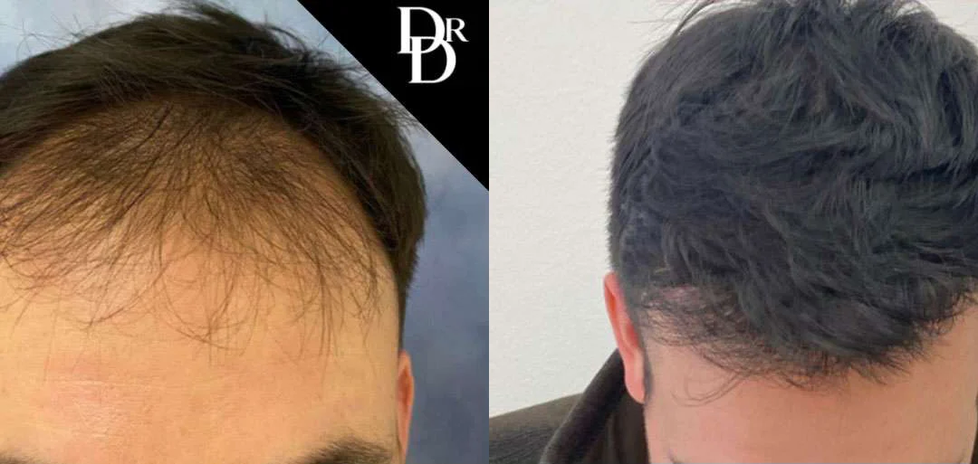 Hair Transplant Before And After Photos By Dr. Demetri Arnaoutakis In Tampa, Fl