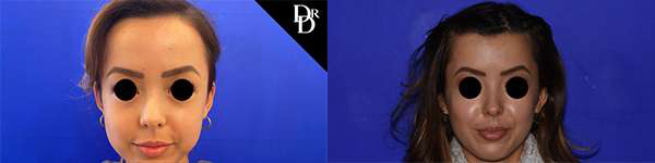 Hairline Lowering Surgery Before And After Photos By Dr. Demetri Arnaoutakis In Tampa, Fl