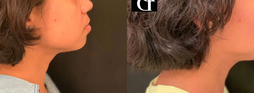 Neck Lift Before And After Photos By Dr. Demetri Arnaoutakis In Tampa, Fl