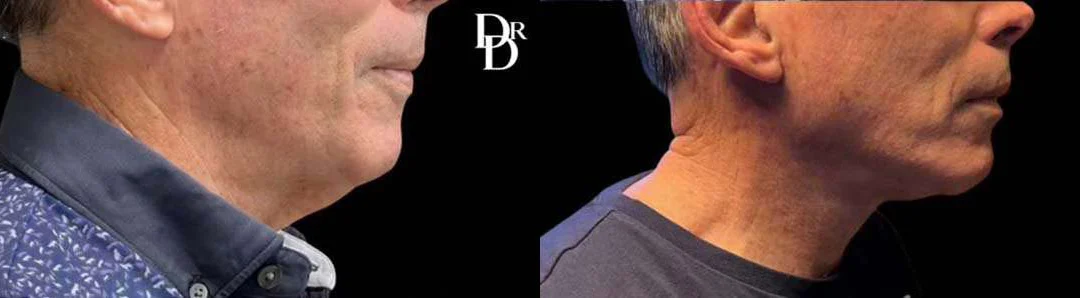 Neck Lift before and after photos by Dr. Demetri Arnaoutakis in Tampa, FL