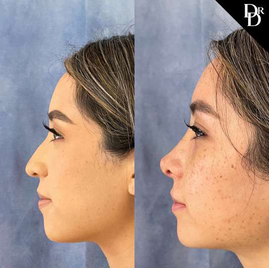 Rhinoplasty before and after photos by Dr. Demetri Arnaoutakis in Tampa, FL
