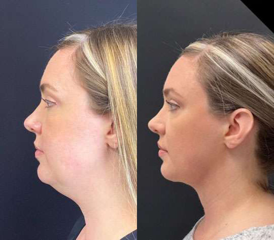 Facetite Before And After Photos By Dr. Demetri Arnaoutakis In Tampa, Fl