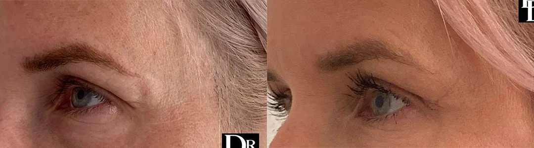 Eyelid Surgery before and after photos by Dr. Demetri Arnaoutakis in Tampa, FL