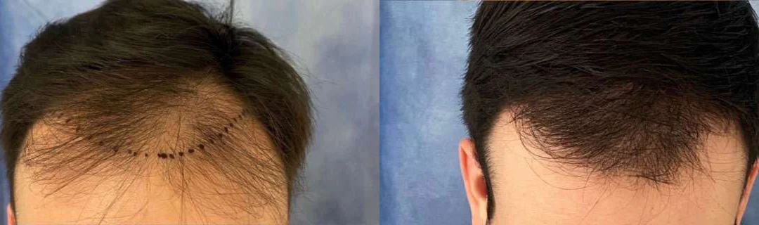 Hair Transplant Before And After Photos By Dr. Demetri Arnaoutakis In Tampa, Fl