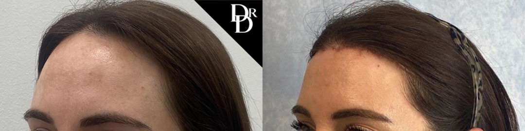 Hairline Lowering Surgery Before And After Photos By Dr. Demetri Arnaoutakis In Tampa, Fl