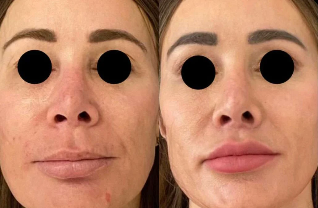 Lip Lift before and after photos by Dr. Demetri Arnaoutakis in Tampa, FL