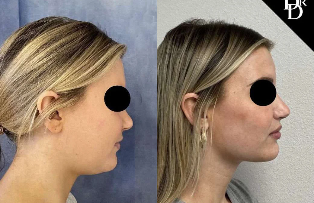 Neck Lift Before And After Photos By Dr. Demetri Arnaoutakis In Tampa, Fl