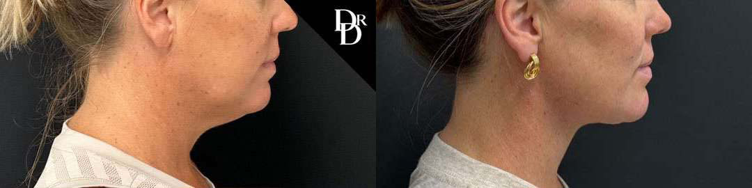 Neck Lift before and after photos by Dr. Demetri Arnaoutakis in Tampa, FL